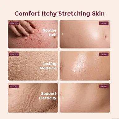 Momcozy Pro-Collagen Stretch Mark Cream in Kenya